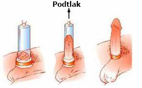 vakuova pumpa s erekcnym kruzkom